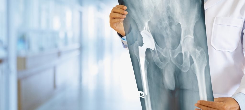 Xray showing a defective metal hip implant in a patient. The hip implant was recalled and the patient requires hip revision surgery.