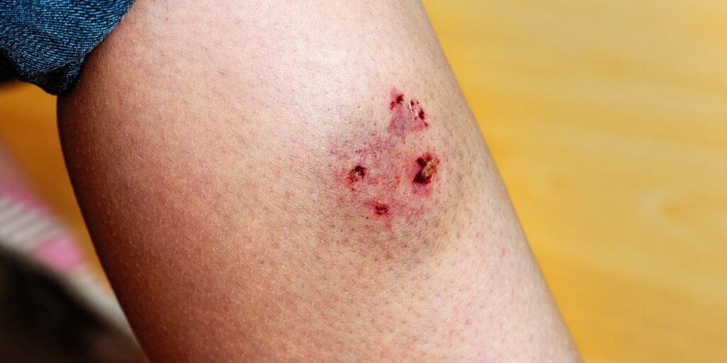 Dog bite injuries can be both physically and emotionally traumatic