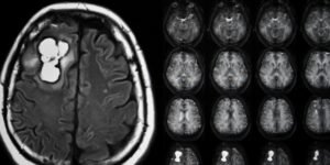 Hire a top Toronto personal injury lawyer for your brain injury claim