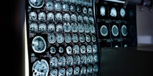 Concussions are often “invisible” injuries with real cognitive, visual, and vestibular consequences that can affect work, school, and family life